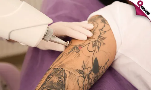 Laser Tattoo Removal!